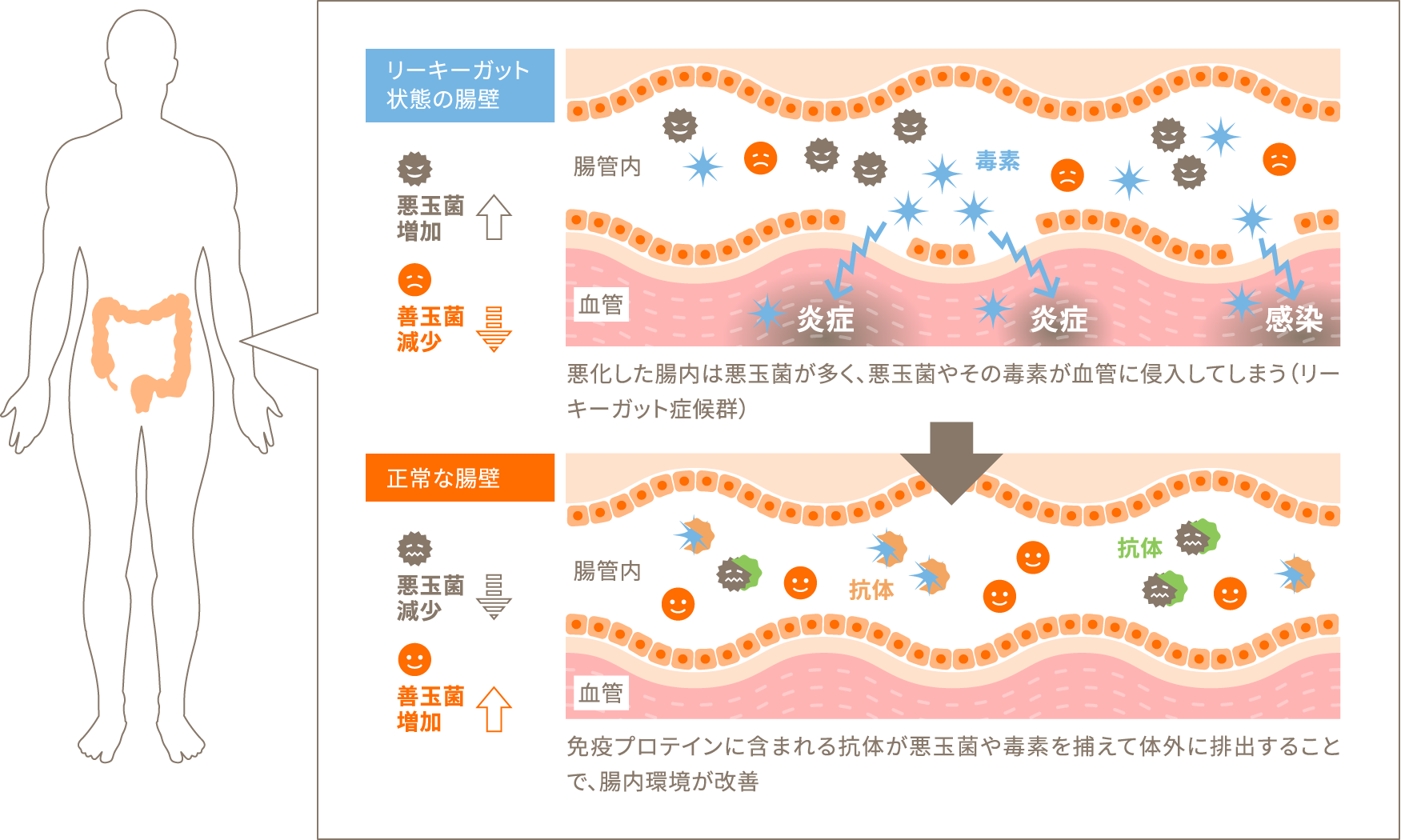 リーキーガット症候群